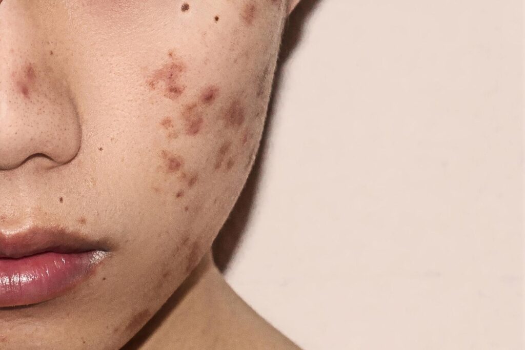 Korean Skincare For Acne